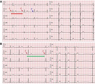 Case report: Sudden unexpected death due to tuberculous myocarditis involving sinus node at autopsy